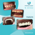 Implants - Derman Dent - Dental Clinic