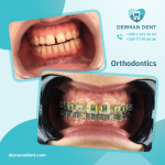 Orthodontics - Derman Dent - Dental Clinic