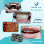 Zirconia Implants - Derman Dent - Dental Clinic