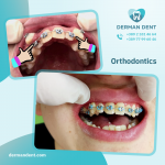 Orthodontics - Derman Dent - Dental Clinic