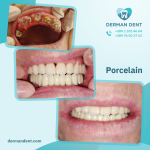 Porcelain - Derman Dent - Dental Clinic
