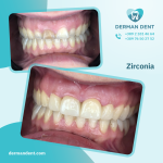 Zirconia - Derman Dent - Dental Clinic