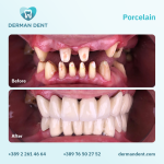 Porcelain - Derman Dent - Dental Clinic