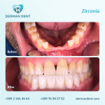 Zirconia - Derman Dent - Dental Clinic
